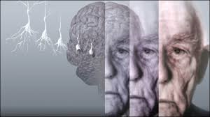 آلزایمر چگونه آغاز می شود؟