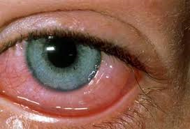 آشنایی با حساسیت‌های چشمی و درمان آن‌ها