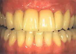 پیشگیری از زرد شدن دندان ها